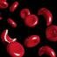 серповидно-клеточная анемия