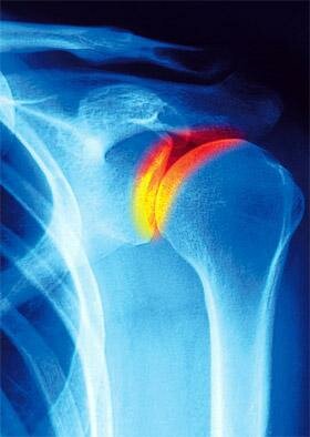 Плечевой артрит - причины и симптомы