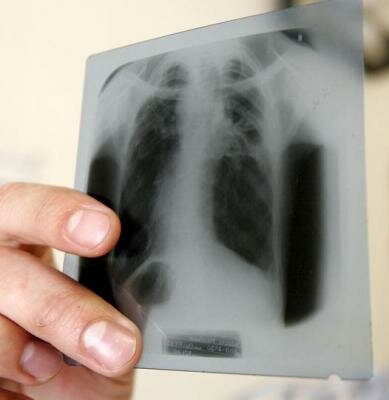 Как определить туберкулез пациенту?