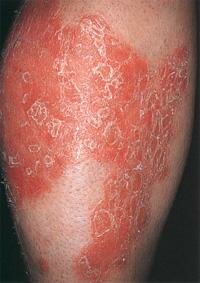 Шелушащаяся сыпь на коленях – признак псориаза